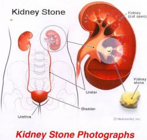 Kidney_stone_1