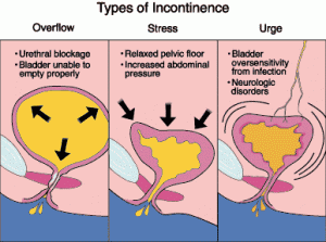 Urinary Incontinence  Fort Myers, Bonita, Cape Coral, Punta Gorda