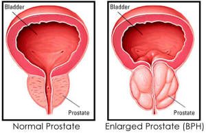 Florida Urology Physicians Fort Myers Men with an enlarged Prostate