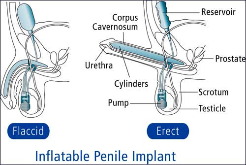 Erectile Dysfunction Florida Urology Physicians